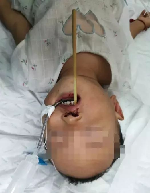 車上慎食烤腸，兩歲男孩遭遇食品安全事故的警示故事