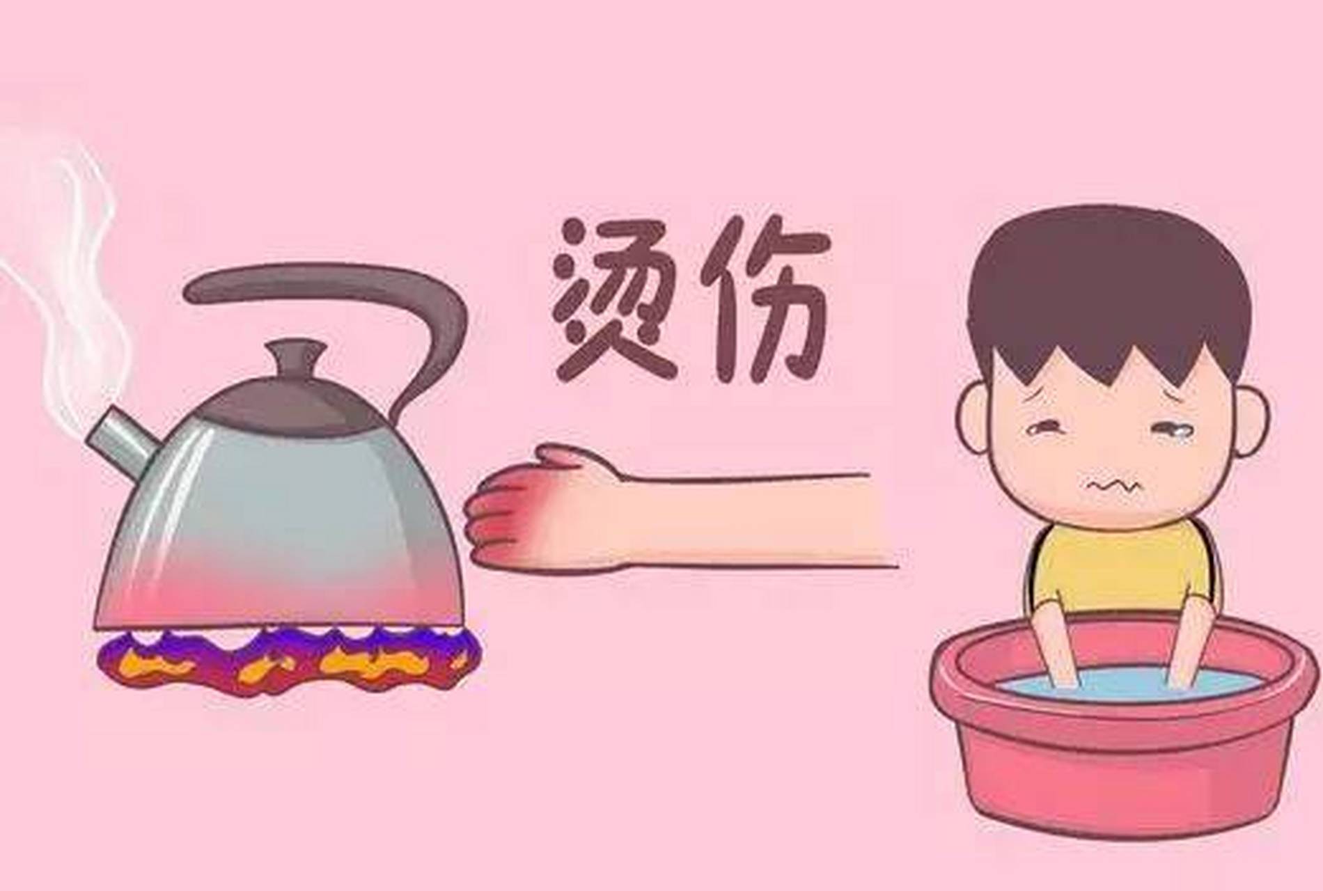 家庭急救指南，小孩燙傷處理步驟